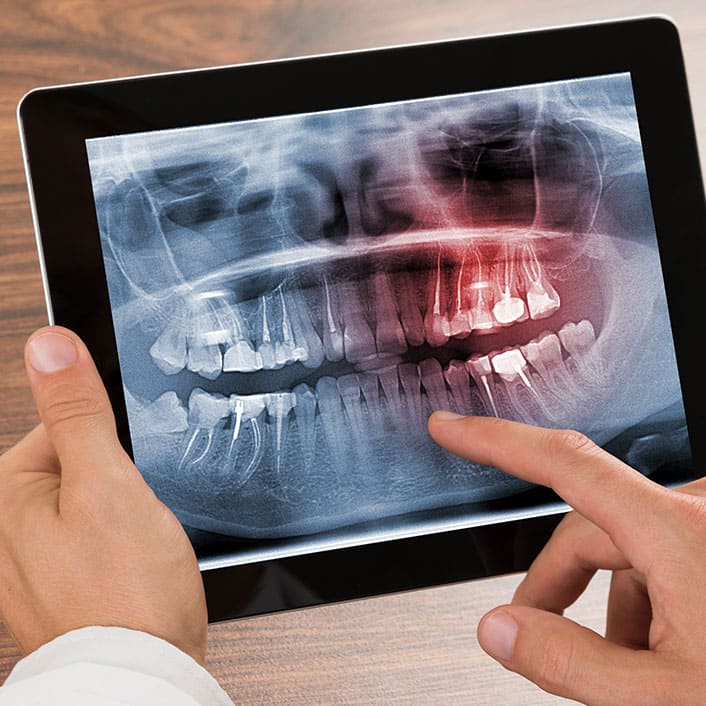 Close-up of a dental x-ray image showing teeth and jaw structure.