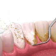 Dental hygienist performing a professional dental cleaning on a patient.